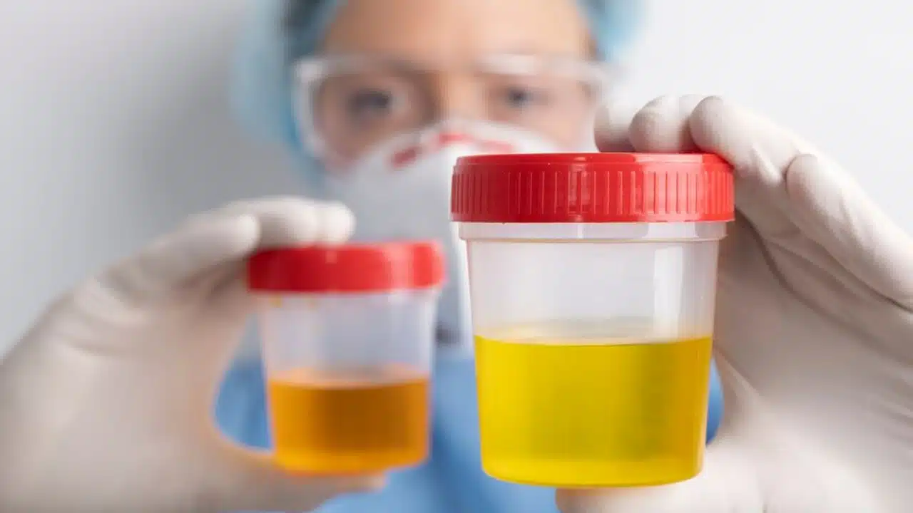 Urine Colours Alert : మీ యూరిన్ రంగు కిడ్నీల ఆరోగ్యాన్ని తెలియజేస్తుంది... ఈ రంగులో ఉంటే కిడ్నీలు ప్రమాదంలో ఉన్నట్లే...?