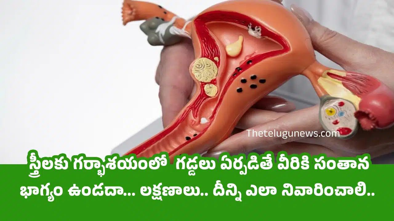 Uterine Fibroids : స్త్రీలకు గర్భాశయంలో గడ్డలు ఏర్పడితే వీరికి సంతాన భాగ్యం ఉండదా... లక్షణాలు.. దీన్ని ఎలా నివారించాలి...?