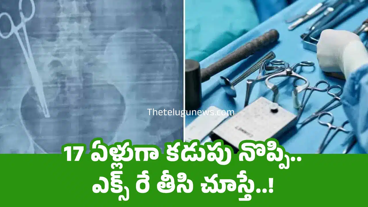 Woman Stomach : 17 ఏళ్లుగా క‌డుపు నొప్పి.. ఎక్స్ రే తీసి చూస్తే..!