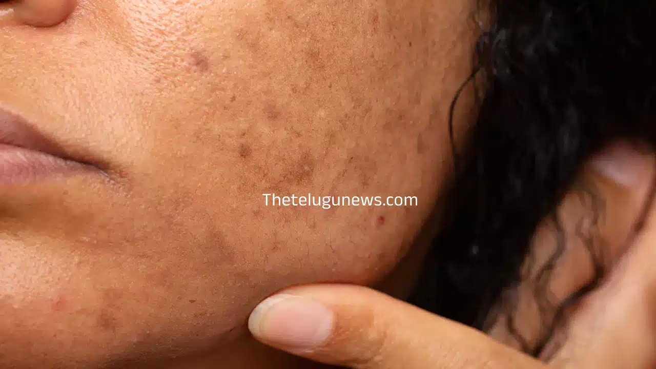 Skin Pigmentation : ముఖంపై మంగు మచ్చలు ఎందుకొస్తాయో తెలుసా... ఈ టిప్స్ తో మటుమాయం...?