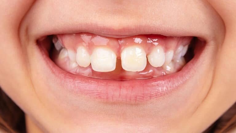 Gap In Teeth : మీ పళ్ళ మధ్య గ్యాప్ ఉందా.. ఇటువంటి వ్యక్తులు చాలా డేంజర్…వీరి గురించి తెలిస్తే షాక్ అవ్వాల్సిందే…?