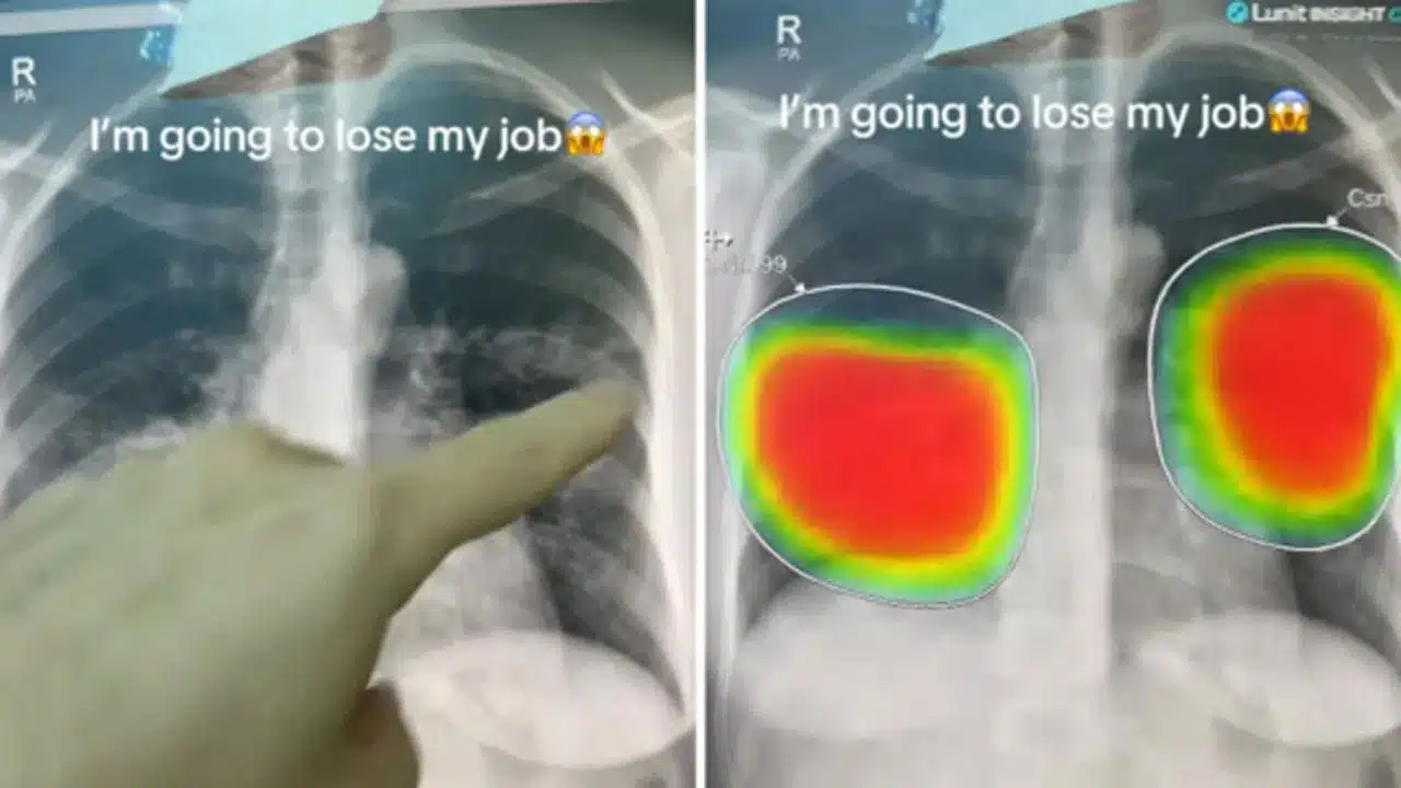 AI Analyses X-Ray : ఎక్స్-రేను చూసి జ‌బ్బు ఖచ్చితత్వాన్ని చెప్పిన ఏఐ.. తన ఉద్యోగం పోతుందన్న వైద్యుడు