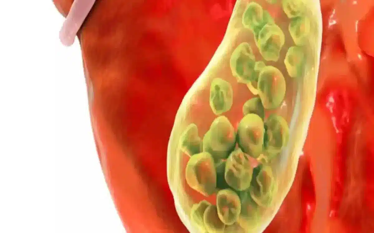 Gallstones : పిత్తాశయ రాళ్లు ఎలా ఏర్పడతాయి? లక్షణాలు & కారణాలు