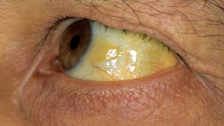 Jaundice : అసలు కామెర్లు ఎందుకు వస్తాయో మీకు తెలుసా… కళ్ళు, గోర్లు పచ్చగా ఎలా మారుతాయి.. కారణం ఇదే…?