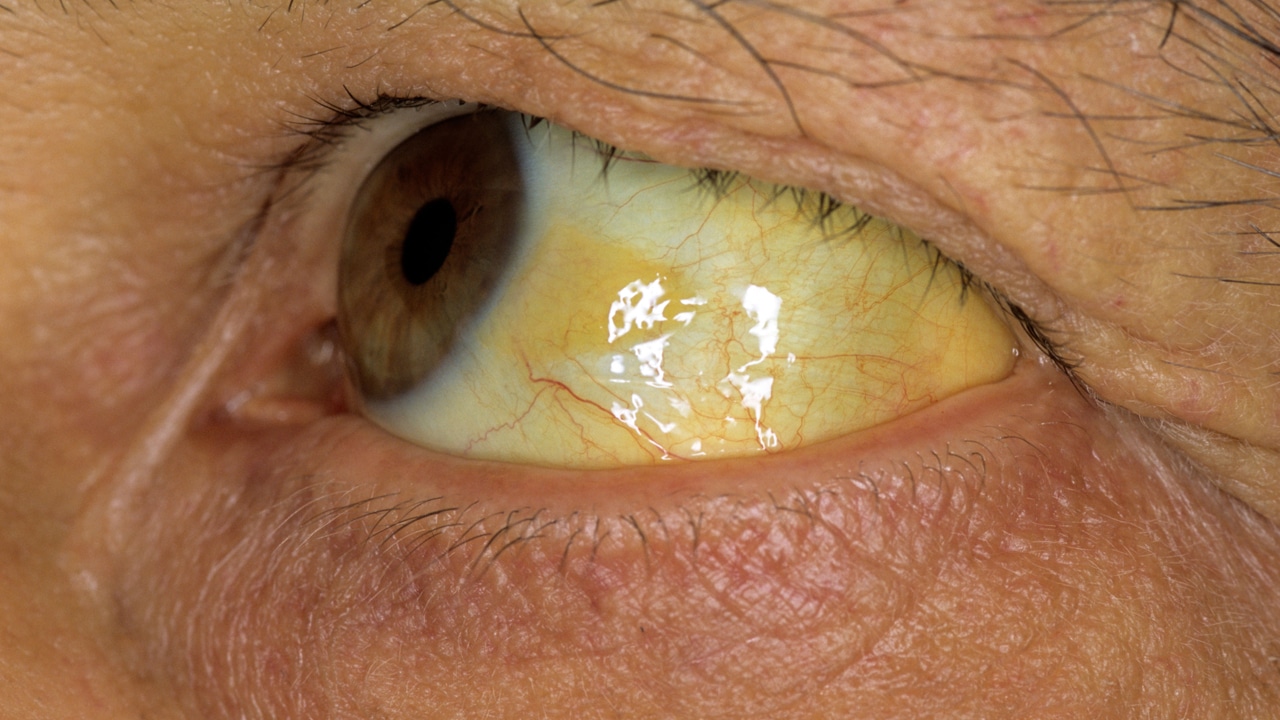 Jaundice : అసలు కామెర్లు ఎందుకు వస్తాయో మీకు తెలుసా… కళ్ళు, గోర్లు పచ్చగా ఎలా మారుతాయి.. కారణం ఇదే…?