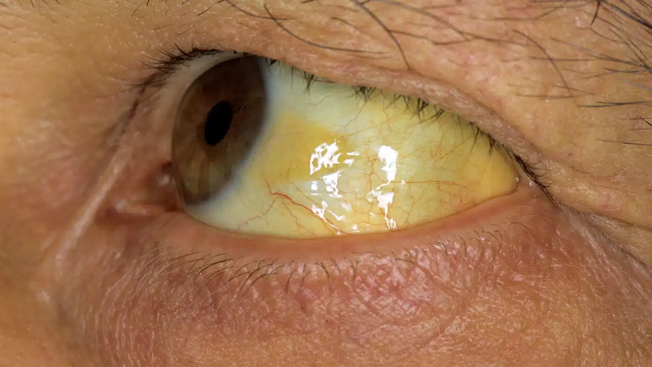Jaundice : అసలు కామెర్లు ఎందుకు వస్తాయో మీకు తెలుసా... కళ్ళు, గోర్లు పచ్చగా ఎలా మారుతాయి.. కారణం ఇదే...?