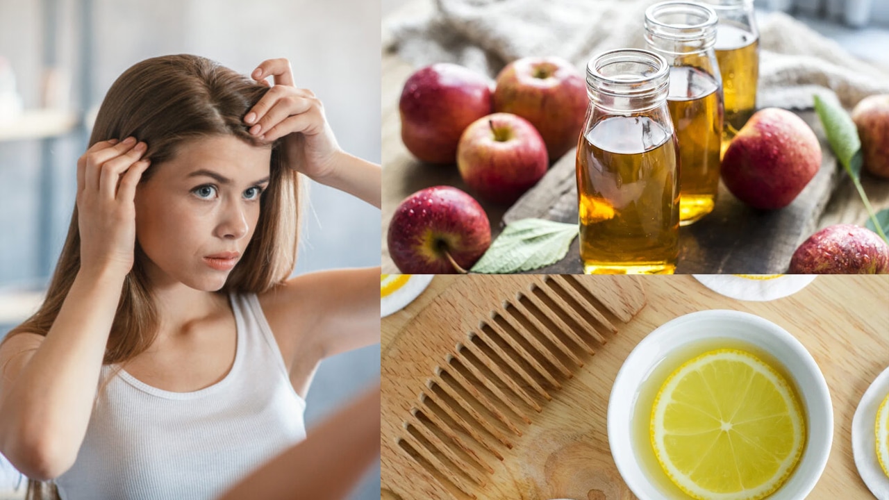 Dandruff Tips : తలపై చుండ్రు  సమస్య తగ్గాలంటే…. ఈ 5 రకాల చిట్కాలు చాలు.. శాశ్వత పరిష్కారం…?