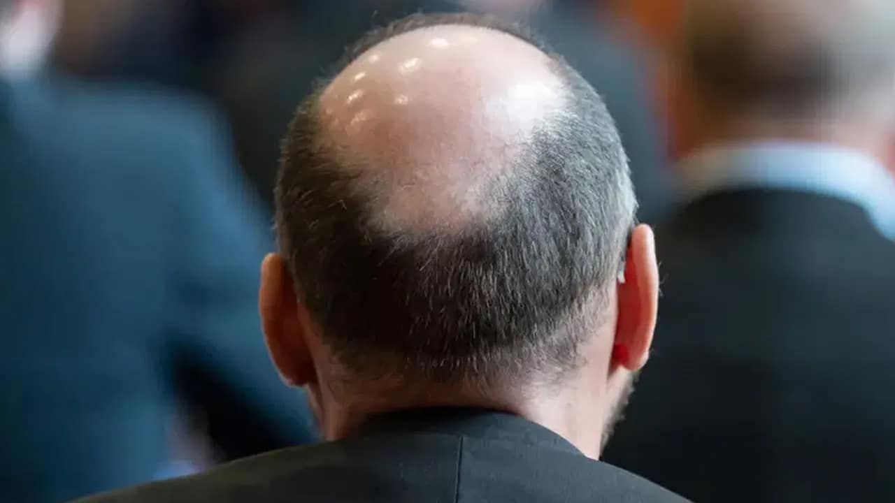 Hair Loss : అయ్యయ్యో.. బట్టతల వస్తుందని బాధపడుతున్నారా… ఇలా చేయండి వెంటనే వెంట్రుకలు మొలుస్తాయి…?