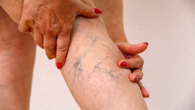 Health Tips : కాళ్లపై ఇలాంటి సిరల చారలు కనిపిస్తే… నిర్లక్ష్యం చేయకండి… యమ డేంజర్…?