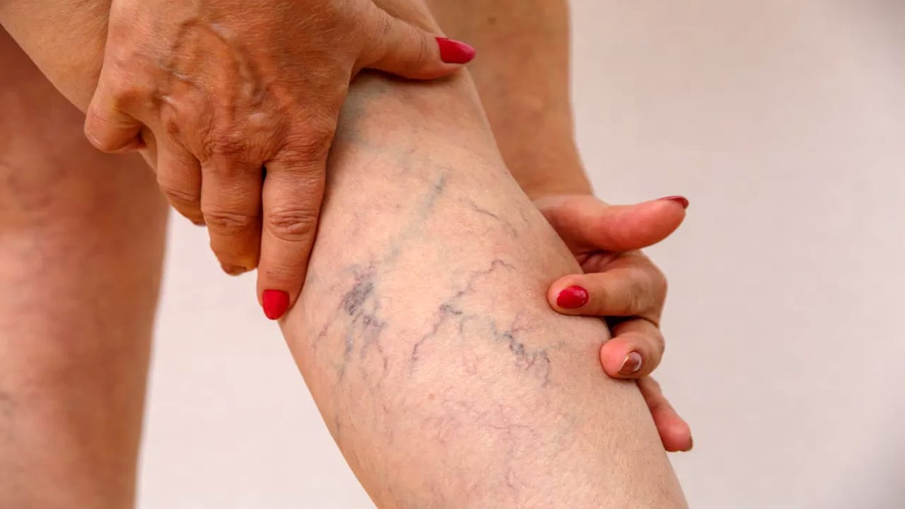 Health Tips : కాళ్లపై ఇలాంటి సిరల చారలు కనిపిస్తే… నిర్లక్ష్యం చేయకండి… యమ డేంజర్…?