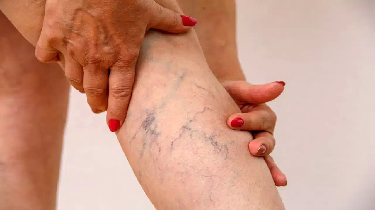 Health Tips : కాళ్లపై ఇలాంటి సిరల చారలు కనిపిస్తే... నిర్లక్ష్యం చేయకండి... యమ డేంజర్...?