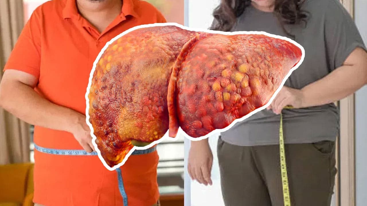 Fatty Liver : ఫ్యాటీ లివర్ సమస్యతో బాధ‌ప‌డుతున్నారా? ఈ తప్పులు మాని, ఈ అలవాట్లు పాటించండి!