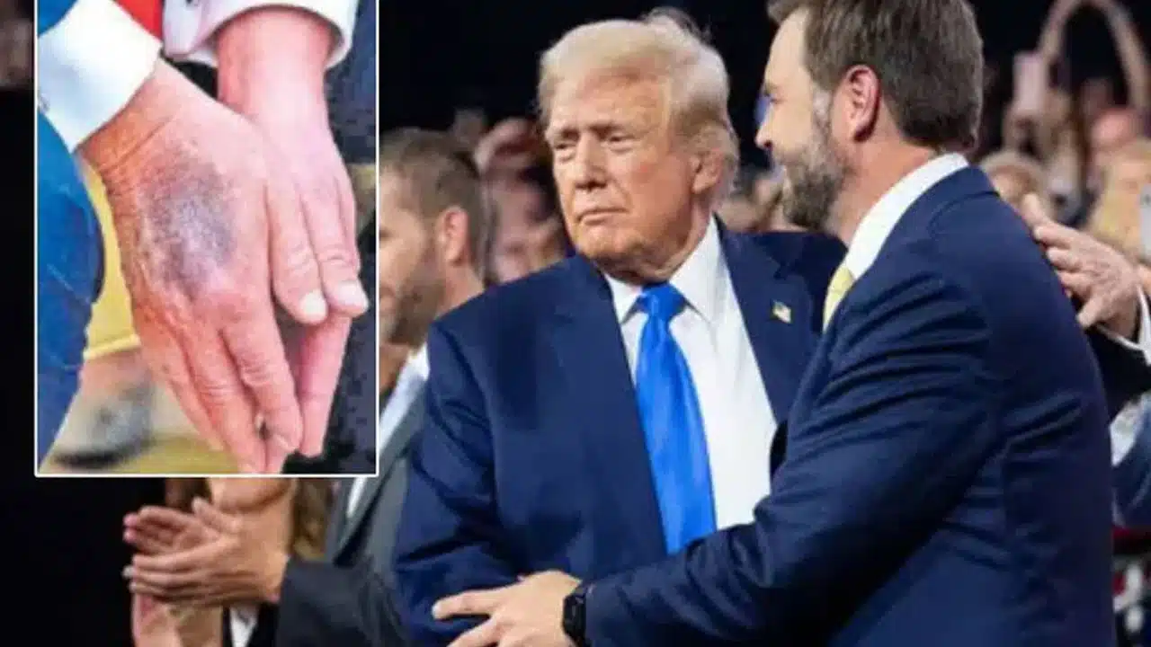 Trump | ట్రంప్ ఆరోగ్యానికి ఏమైంది… ఇవి చూసి అంద‌రిలో టెన్షన్