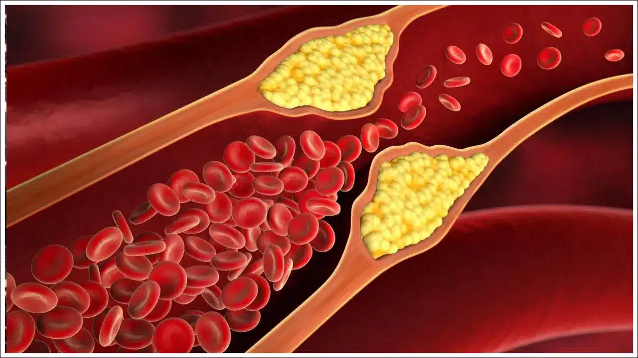 Cholesterol | ముఖంపై కనిపించే లక్షణాలు .. చెడు కొలెస్ట్రాల్ పెరుగుతోందని సంకేతాలు!