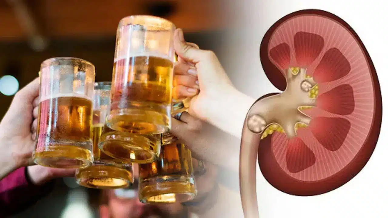 Beer | కిడ్నీ రాళ్లు తొలగించడానికి బీరు తాగాలా.. నిజమెంటీ? అవ‌న్నీ అపోహలేనా?