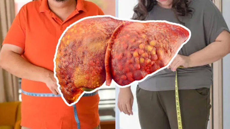 Fatty liver | ఫ్యాటీ లివర్ ఉన్నవారు తప్పక చదవాల్సిన విషయాలు.. ఏం తినాలి?