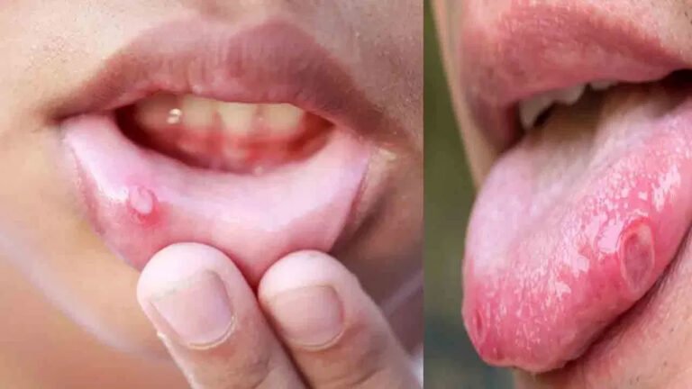Mouth Ulcers | త‌ర‌చుగా నోటి పుండ్లు (మౌత్ అల్సర్లు) .. కారణాలు, నివారణ చిట్కాలు ఇవే!
