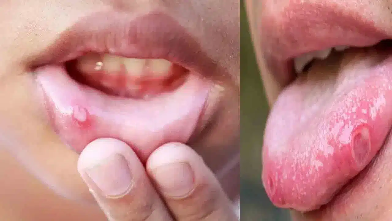Mouth Ulcers | త‌ర‌చుగా నోటి పుండ్లు (మౌత్ అల్సర్లు) .. కారణాలు, నివారణ చిట్కాలు ఇవే!