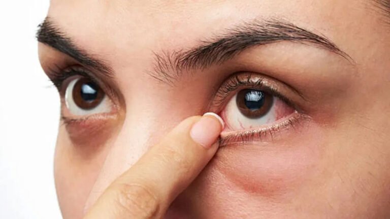 Dry Eyes | కళ్ళు పొడిబారడం వ‌ల‌న పెరుగుతున్న సమస్య .. కారణాలు, లక్షణాలు, జాగ్రత్తలు ఇవే