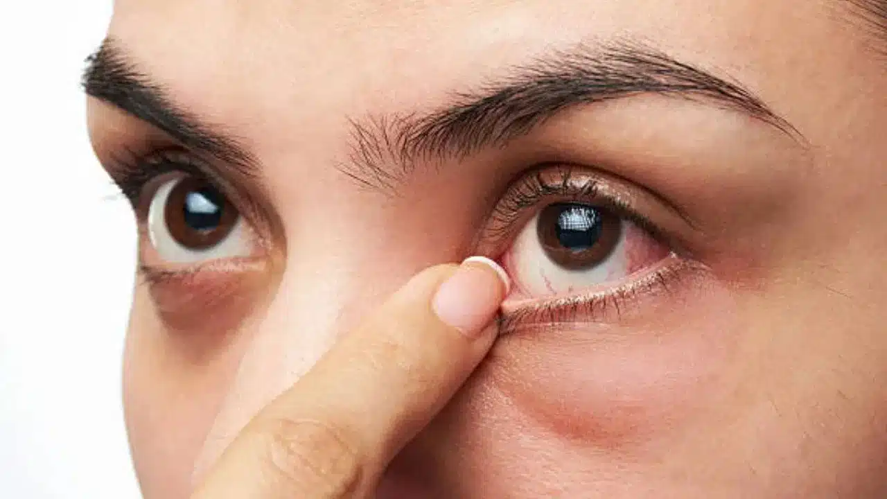 Dry Eyes | కళ్ళు పొడిబారడం వ‌ల‌న పెరుగుతున్న సమస్య .. కారణాలు, లక్షణాలు, జాగ్రత్తలు ఇవే