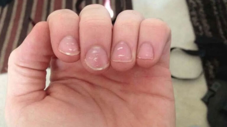 Nails | గోళ్లపై తెల్లని మచ్చల అర్థం ఏమిటి? .. శుభ సంకేతాలుగా జ్యోతిష నిపుణుల అభిప్రాయం