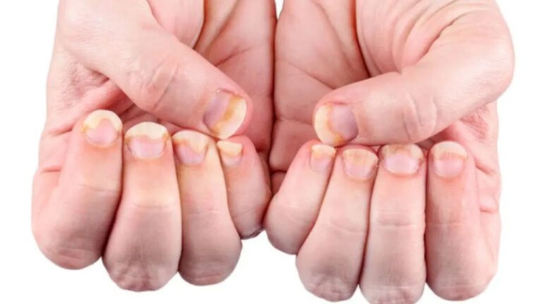 Vitamin B12 | చేతి, కాళ్ల గోళ్లు తరచుగా విరిగిపోతున్నాయా.. విటమిన్ బి12 లోపమే కారణమా!