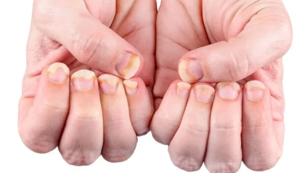 Vitamin B12 | చేతి, కాళ్ల గోళ్లు తరచుగా విరిగిపోతున్నాయా.. విటమిన్ బి12 లోపమే కారణమా!