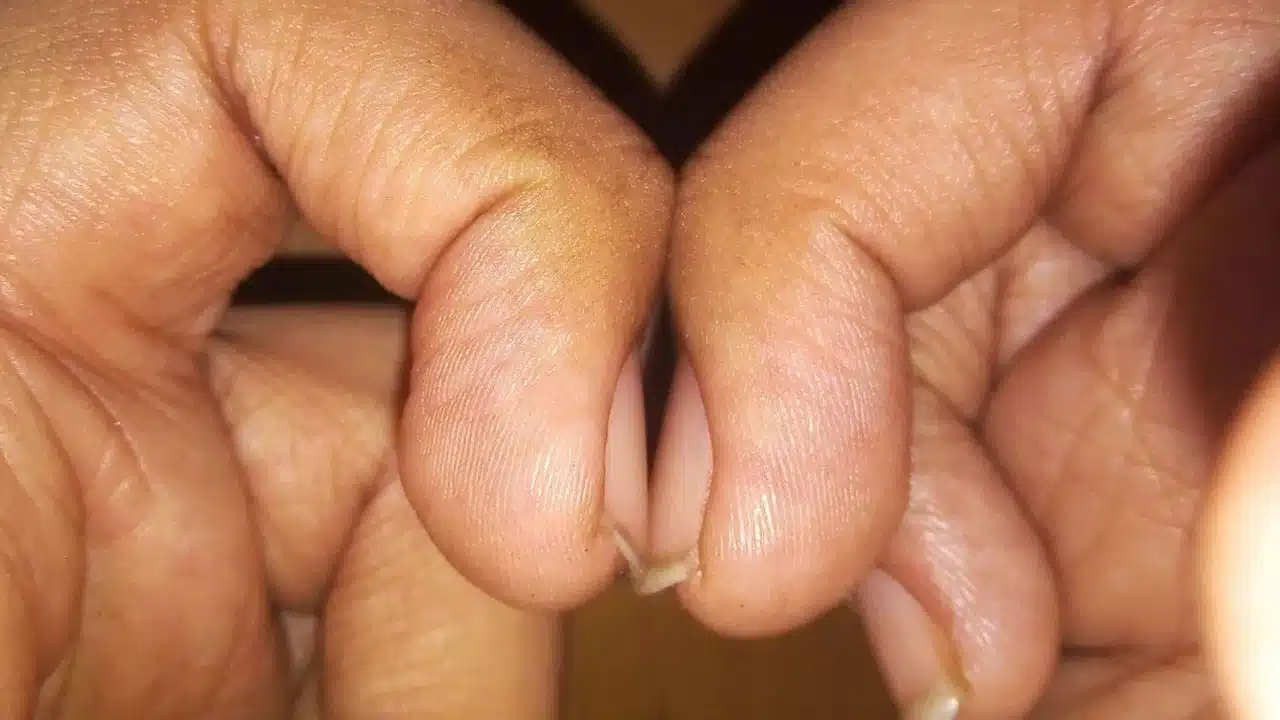 The secret of cancer hidden in nails