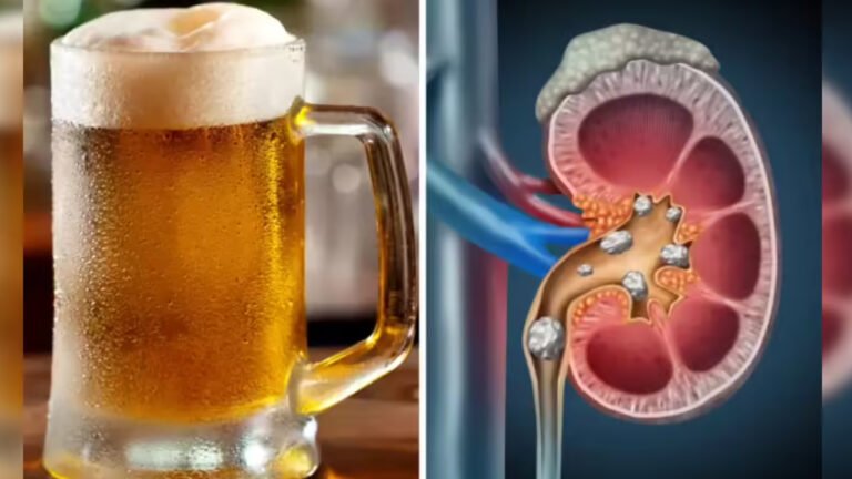 Beer Kidney Stones : కిడ్నీలో రాళ్లు ఉంటే బీర్ తాగమంటారా? ఈ అపోహ వెనుక వాస్తవాలు ఇవే!