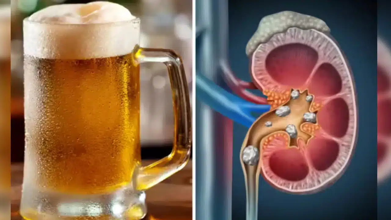 Beer Kidney Stones : కిడ్నీలో రాళ్లు ఉంటే బీర్ తాగమంటారా? ఈ అపోహ వెనుక వాస్తవాలు ఇవే!