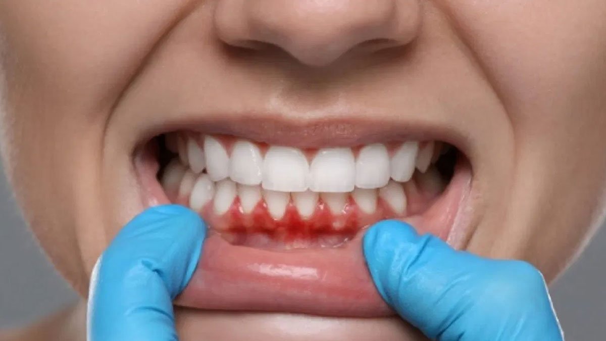 Bleeding Gums : చిగుళ్ల నుంచి రక్తం వస్తోందా? మీ శరీరం ఇస్తున్న డేంజర్ సిగ్నల్ ఇదే..! Bleeding Gums : చిగుళ్ల నుంచి రక్తం వస్తోందా? మీ శరీరం ఇస్తున్న డేంజర్ సిగ్నల్ ఇదే..!